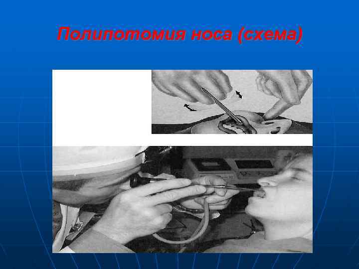 Полипотомия носа (схема) 