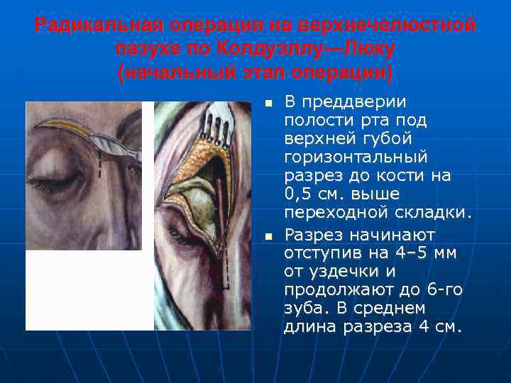 Радикальная операция на верхнечелюстной пазухе по Колдуэллу—Люку (начальный этап операции) В преддверии полости рта