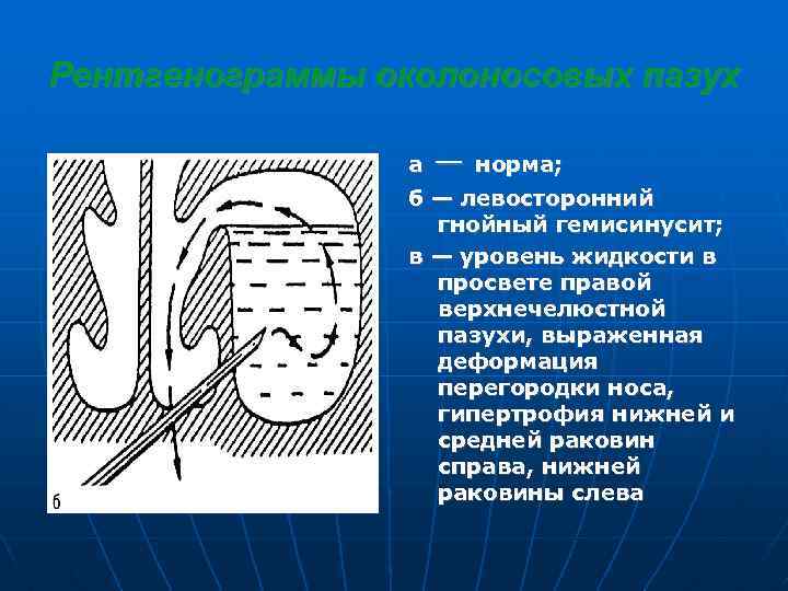 Рентгенограммы околоносовых пазух а — норма; б — левосторонний гнойный гемисинусит; в — уровень