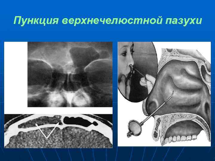 Пункция верхнечелюстной пазухи 