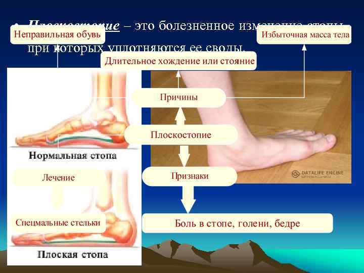  • Плоскостопие – это болезненное изменение стопы, при которых уплотняются ее своды. 