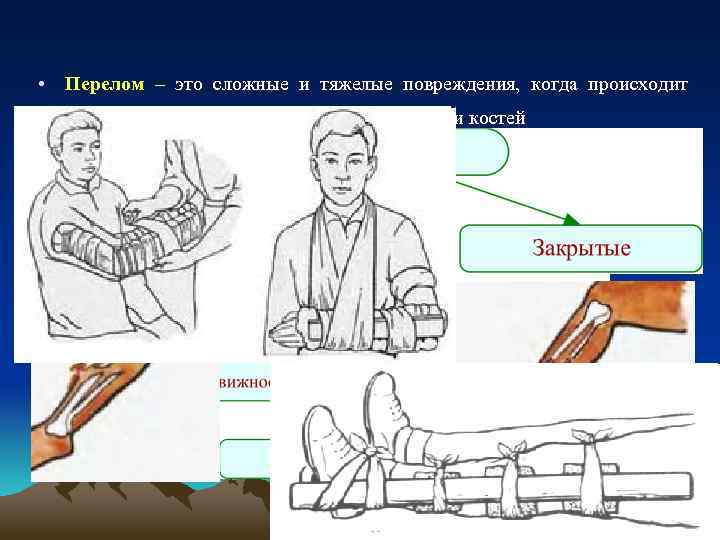  • Перелом – это сложные и тяжелые повреждения, когда происходит частичное или полное