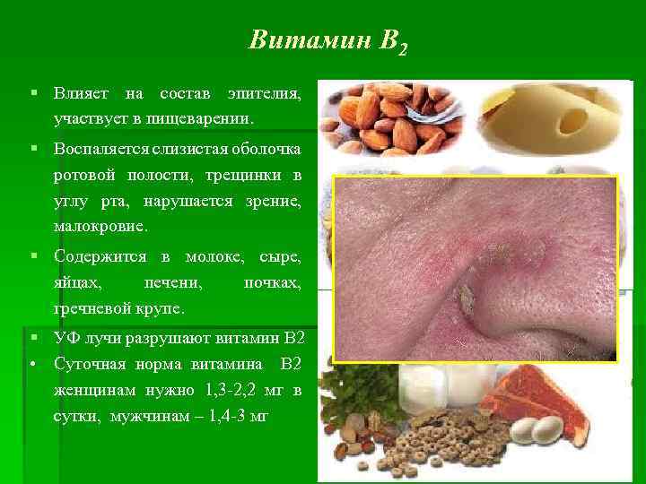 Витамин В 2 § Влияет на состав эпителия, участвует в пищеварении. § Воспаляется слизистая