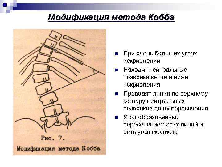 Модификация метода Кобба n n При очень больших углах искривления Находят нейтральные позвонки выше