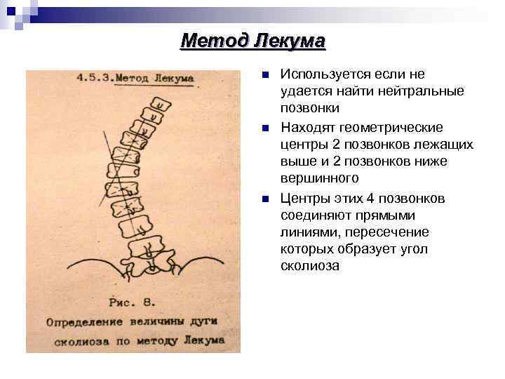 Метод Лекума n n n Используется если не удается найти нейтральные позвонки Находят геометрические