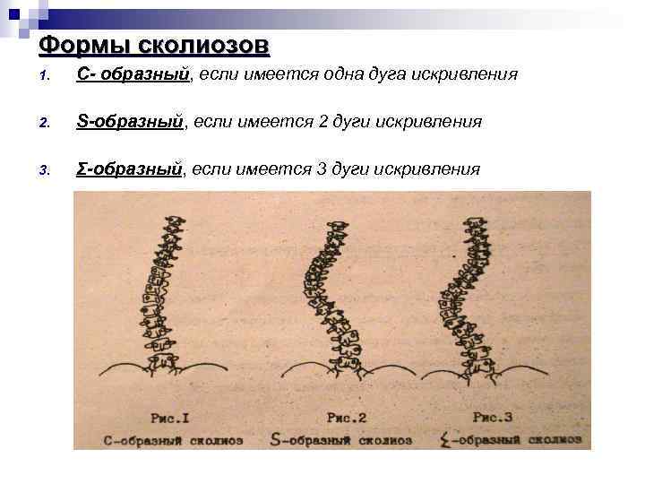 Формы сколиозов 1. С- образный, если имеется одна дуга искривления 2. S-образный, если имеется