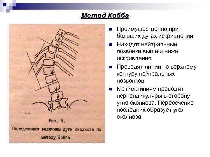Метод Кобба n n Преимущественно при больших дугах искривления Находят нейтральные позвонки выше и
