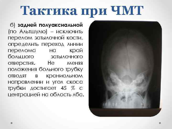 Тактика при ЧМТ б) задней полуаксиальной (по Альтшулю) – исключить перелом затылочной кости, определить