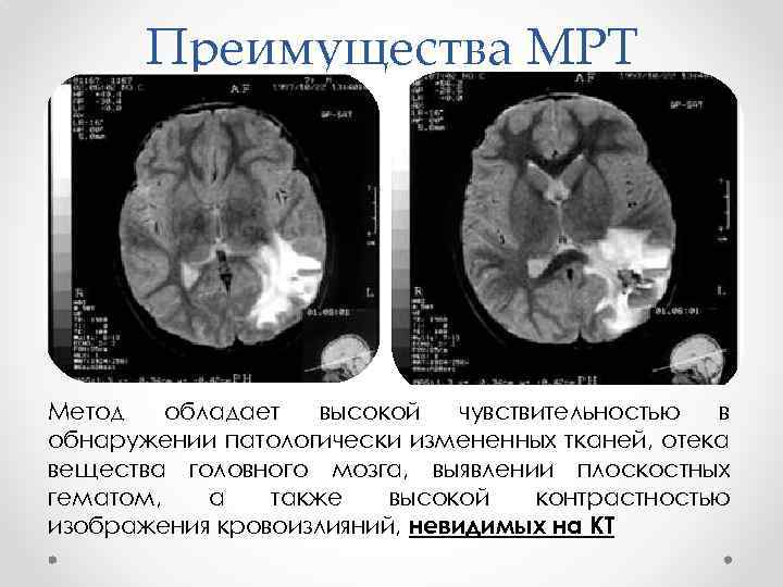 Преимущества МРТ Метод обладает высокой чувствительностью в обнаружении патологически измененных тканей, отека вещества головного