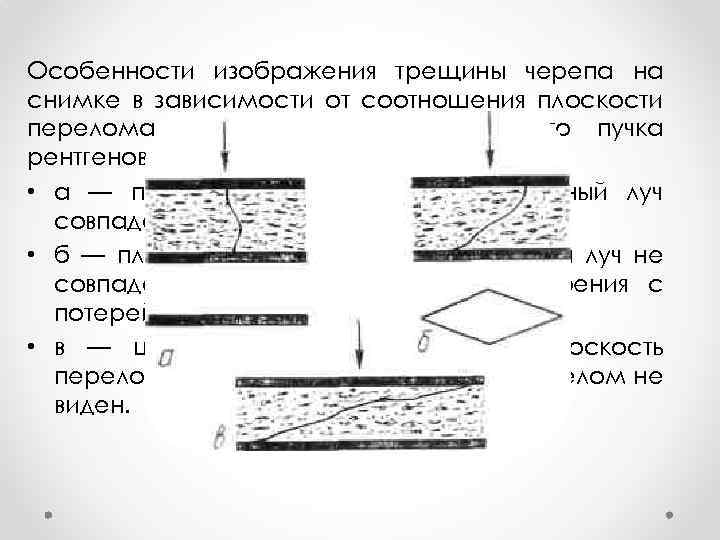 Особенности изображения трещины черепа на снимке в зависимости от соотношения плоскости перелома и направления