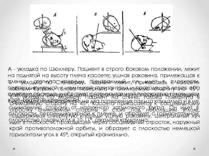 А - укладка по Шюллеру. Пациент в строго боковом положении, лежит на поднятой на