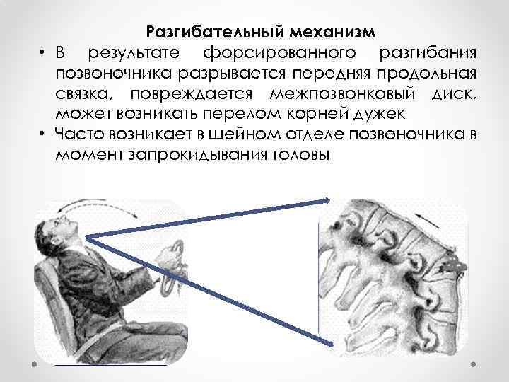 Разгибательный механизм • В результате форсированного разгибания позвоночника разрывается передняя продольная связка, повреждается межпозвонковый