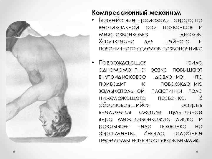 Компрессионный механизм • Воздействие происходит строго по вертикальной оси позвонков и межпозвонковых дисков. Характерно