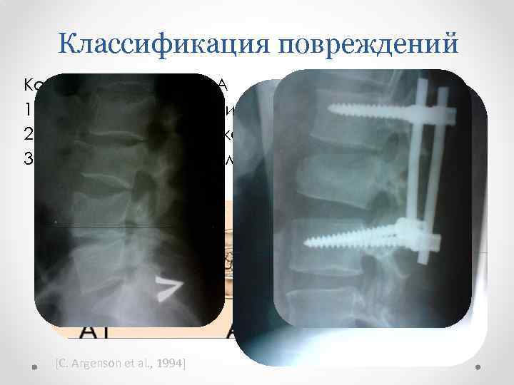 Классификация повреждений Компрессионный тип А 1. Передняя компрессия 2. Компрессионно-оскольчатый перелом 3. «каплевидный» перелом