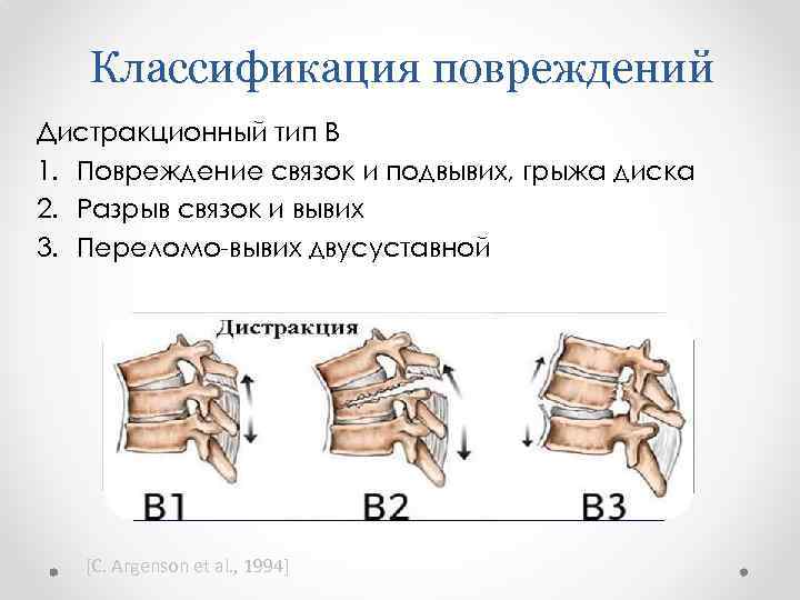 Классификация повреждений Дистракционный тип В 1. Повреждение связок и подвывих, грыжа диска 2. Разрыв