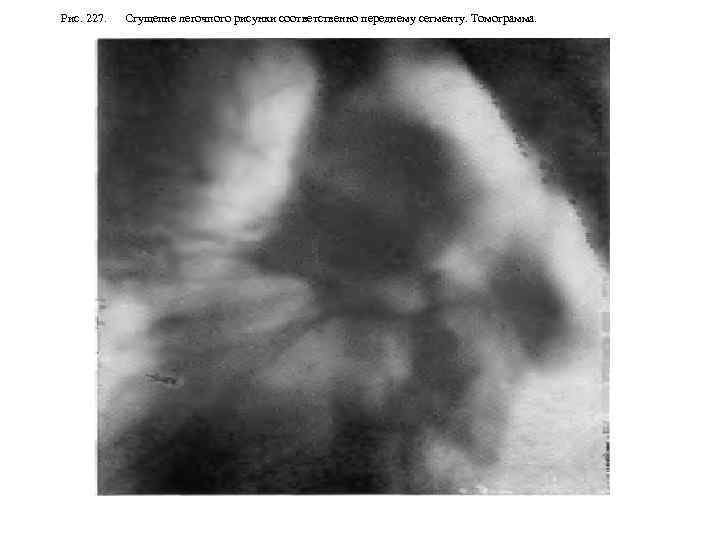 Рис. 227. Сгущепне легочпого рисунки соответственно переднему сегменту. Томограмма. 