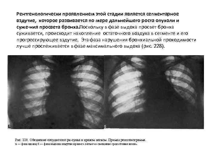 Рентгенологически проявлением этой стадии является сегментарное вздутие, которое развивается по мере дальнейшего роста опухоли
