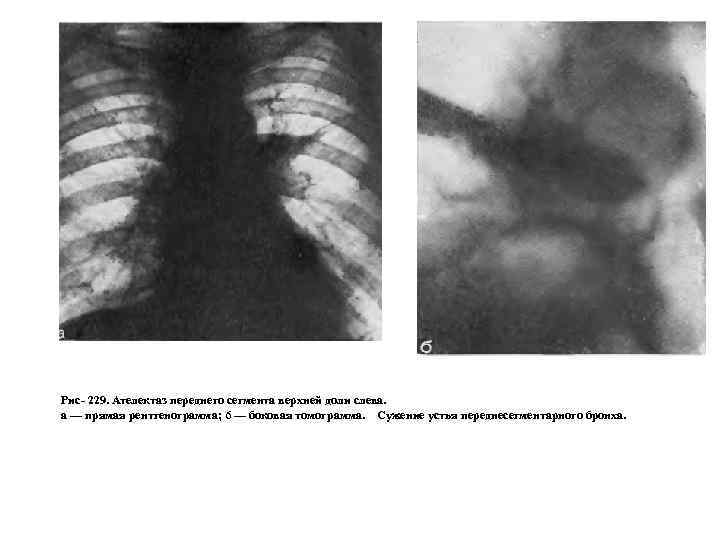 Рис 229. Ателектаз переднего сегмента верхней доли слева. а — прямая рентгенограмма; 6 —