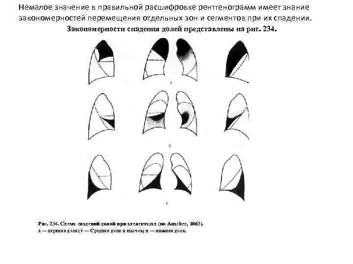 Сегменты легких на рентгенограмме. Ателектаз средней доли схема. Ателектаз доли правого легкого схема. Ателектаз нижней доли правого легкого схема. Схема ателектазов левого легкого.