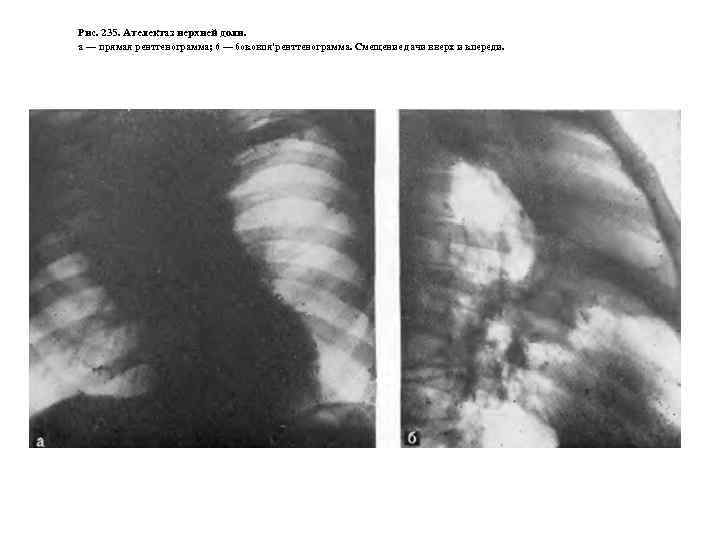 Рис. 235. Ателектаз нерхней доли. а — прямая рентгенограмма; 6 — боковпя'ренттенограмма. Смещение дачи