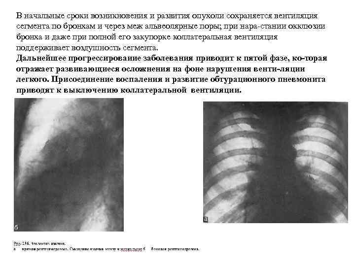 В начальные сроки возникновения и развития опухоли сохраняется вентиляция сегмента по бронхам и через