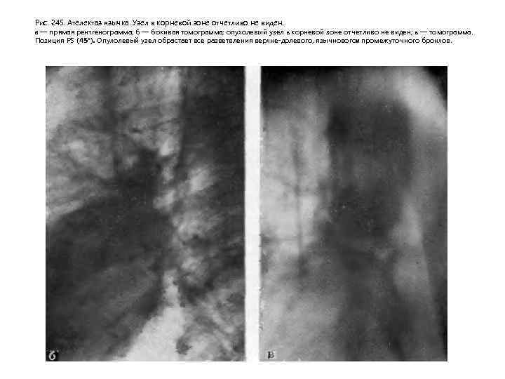 Рис. 245. Ателектаз язычка. Узел в корневой зоне отчетливо не виден. а — прямая