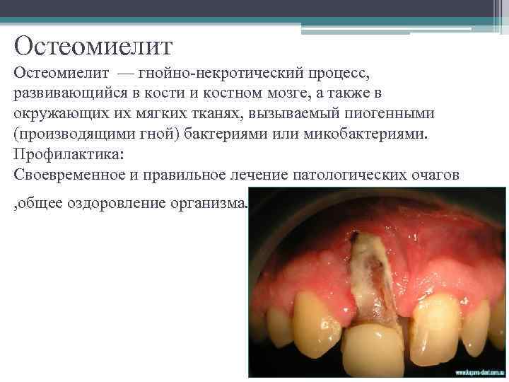 Остеомиелит — гнойно-некротический процесс, развивающийся в кости и костном мозге, а также в окружающих