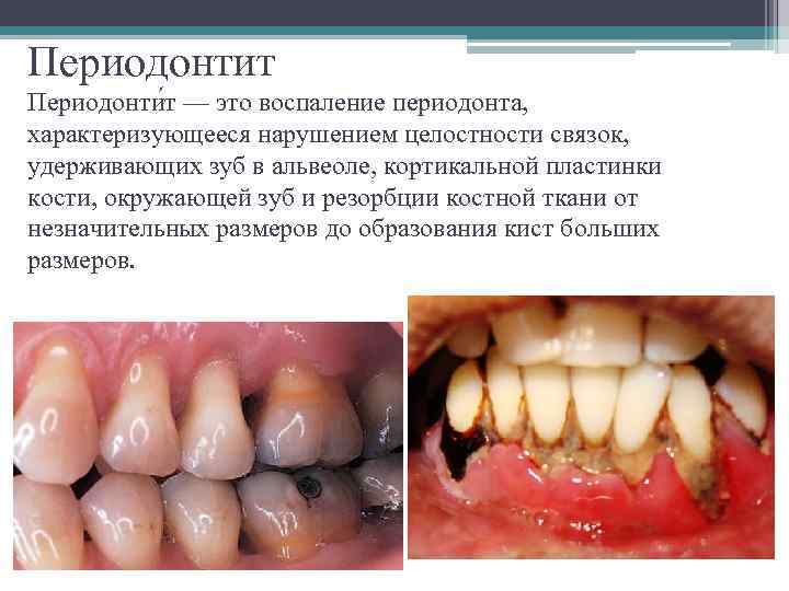 Периодонтит Периодонти т — это воспаление периодонта, характеризующееся нарушением целостности связок, удерживающих зуб в
