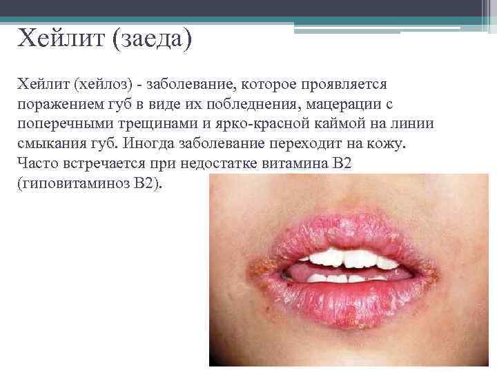 Хейлит (заеда) Хейлит (хейлоз) - заболевание, которое проявляется поражением губ в виде их побледнения,