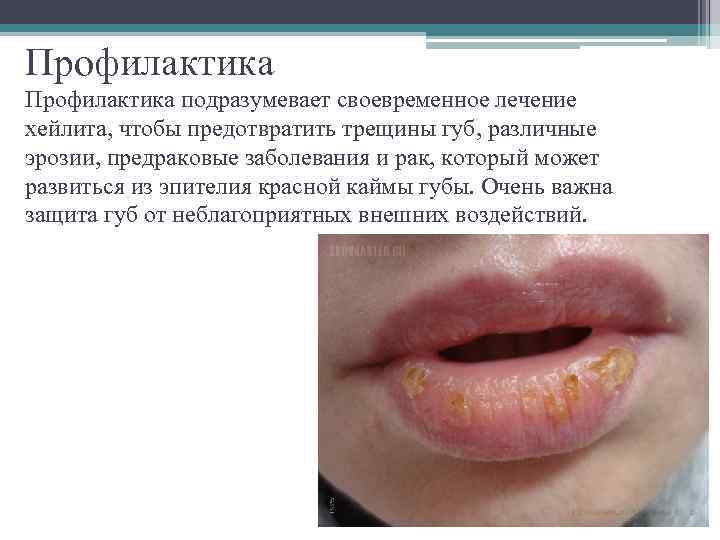 Профилактика подразумевает своевременное лечение хейлита, чтобы предотвратить трещины губ, различные эрозии, предраковые заболевания и