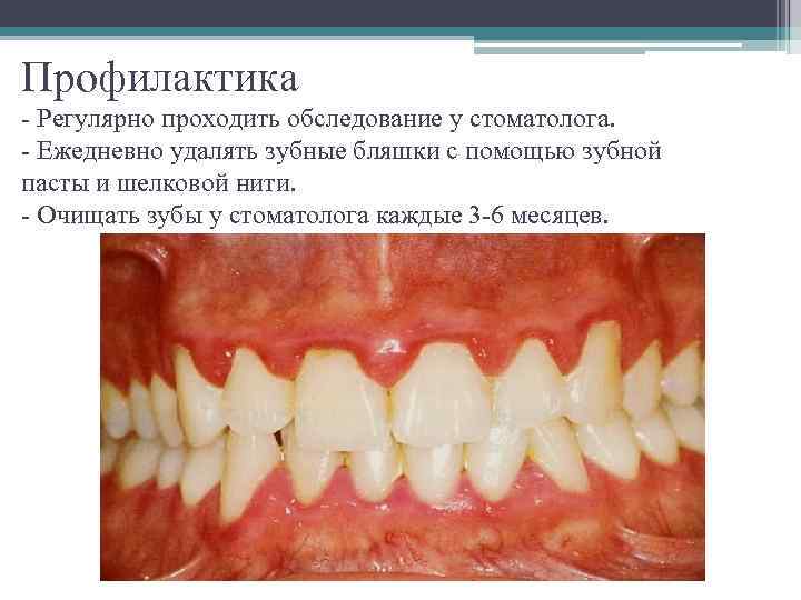 Профилактика - Регулярно проходить обследование у стоматолога. - Ежедневно удалять зубные бляшки с помощью