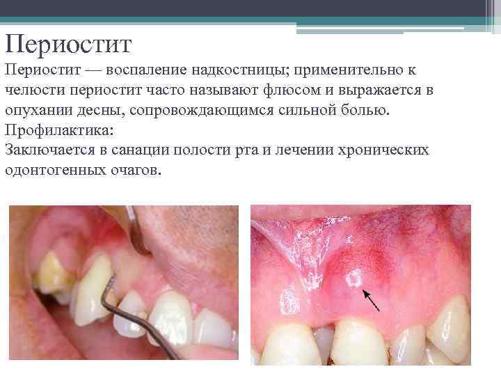Периостит — воспаление надкостницы; применительно к челюсти периостит часто называют флюсом и выражается в