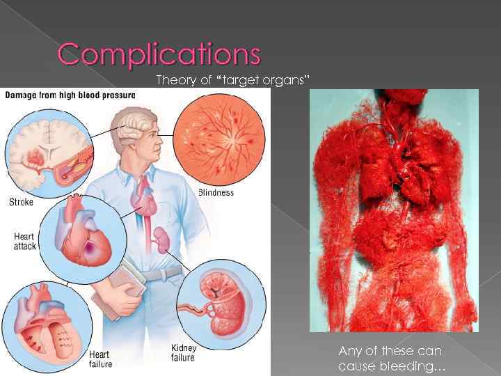 Complications Theory of “target organs” Any of these can cause bleeding… 