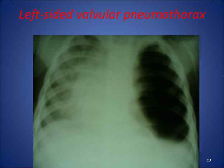 Left-sided valvular pneumothorax 20 