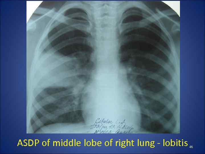 ASDP of middle lobe of right lung - lobitis 46 