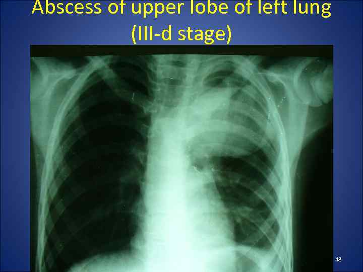 Abscess of upper lobe of left lung (III-d stage) 48 