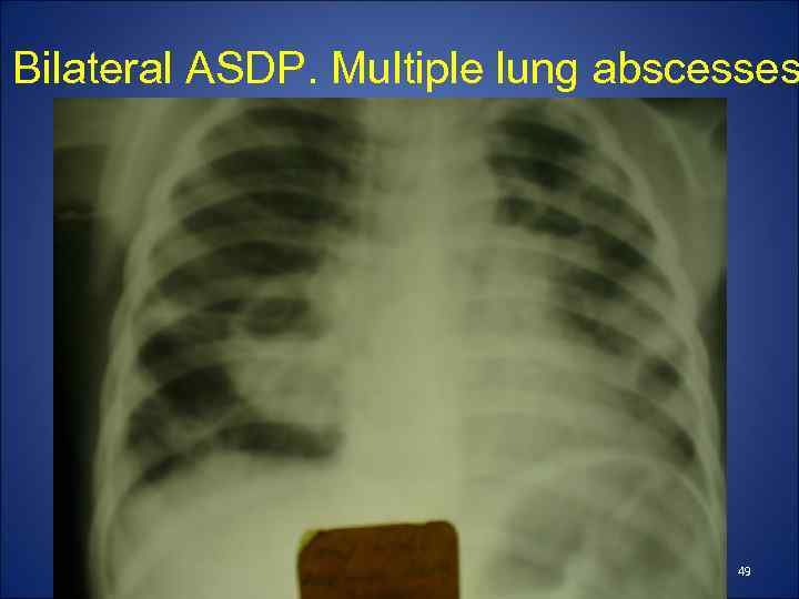 Bilateral ASDP. Multiple lung abscesses 49 