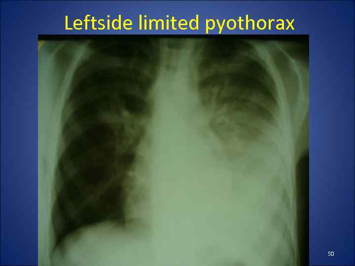 Leftside limited pyothorax 50 