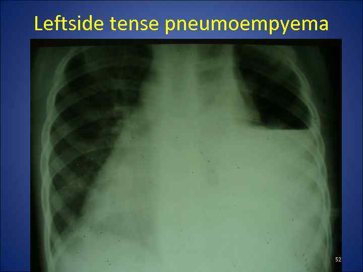 Leftside tense pneumoempyema 52 