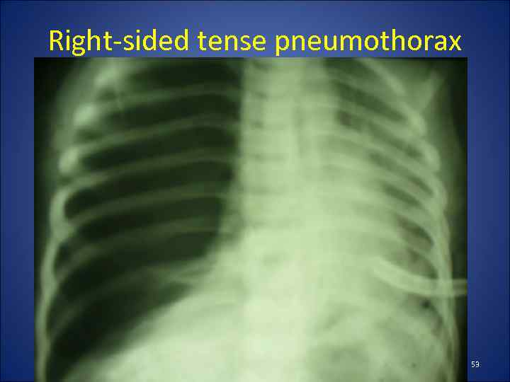 Right-sided tense pneumothorax 53 