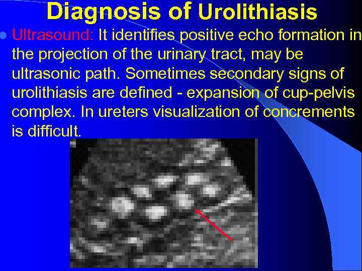 Diagnosis of Urolithiasis l Ultrasound: It identifies positive echo formation in the projection of
