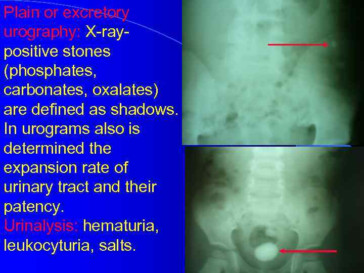 Plain or excretory urography: X-raypositive stones (phosphates, carbonates, oxalates) are defined as shadows. In