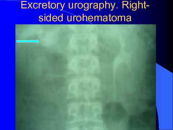 Excretory urography. Rightsided urohematoma 