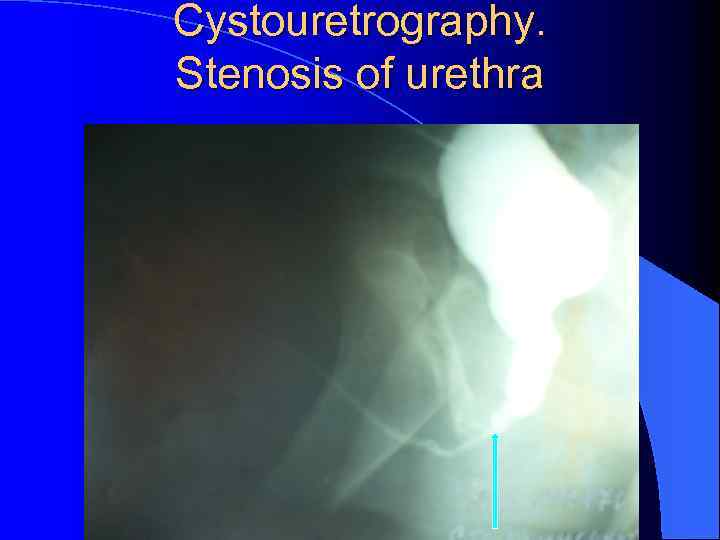 Cystouretrography. Stenosis of urethra 