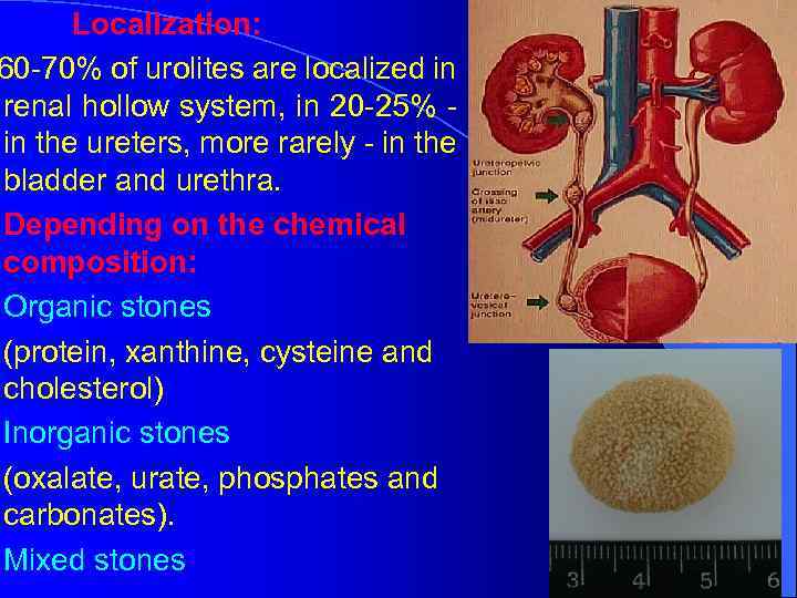  Localization: 60 -70% of urolites are localized in renal hollow system, in 20