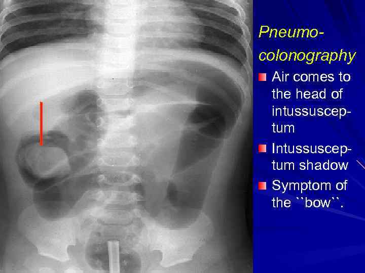Pneumocolonography Air comes to the head of intussusceptum Intussusceptum shadow Symptom of the ``bow``.