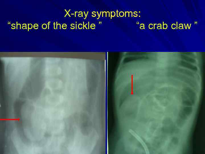 X-ray symptoms: “shape of the sickle ” “a crab claw ” 