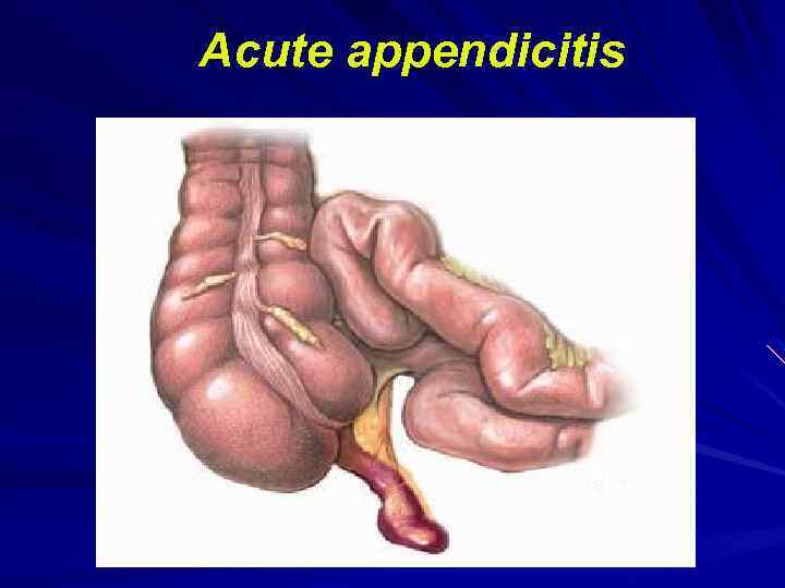  Acute appendicitis 