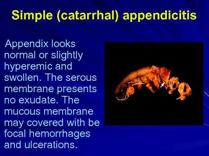 Simple (catarrhal) appendicitis Appendix looks normal or slightly hyperemic and swollen. The serous membrane