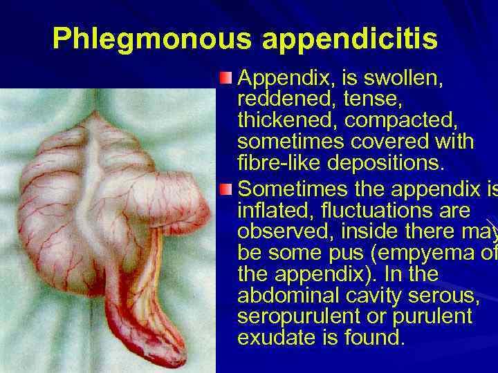 Phlegmonous appendicitis Appendix, is swollen, reddened, tense, thickened, compacted, sometimes covered with fibre-like depositions.